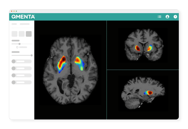 QMENTA-trials-Parkinsons