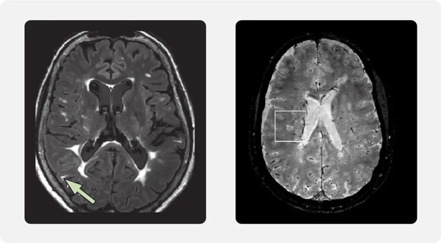 blog-central-vein-brains