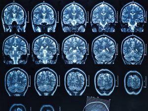 The role of CT and MR in stroke patients - QMENTA